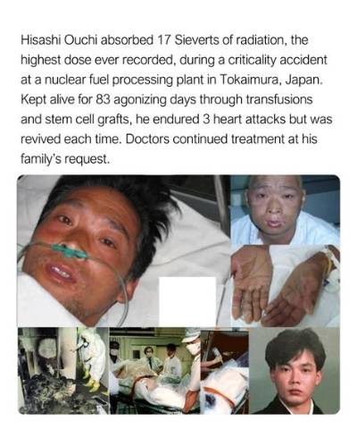 Hisashi Ouchi Medical Photos: a Tragic Case of Radiation Exposure